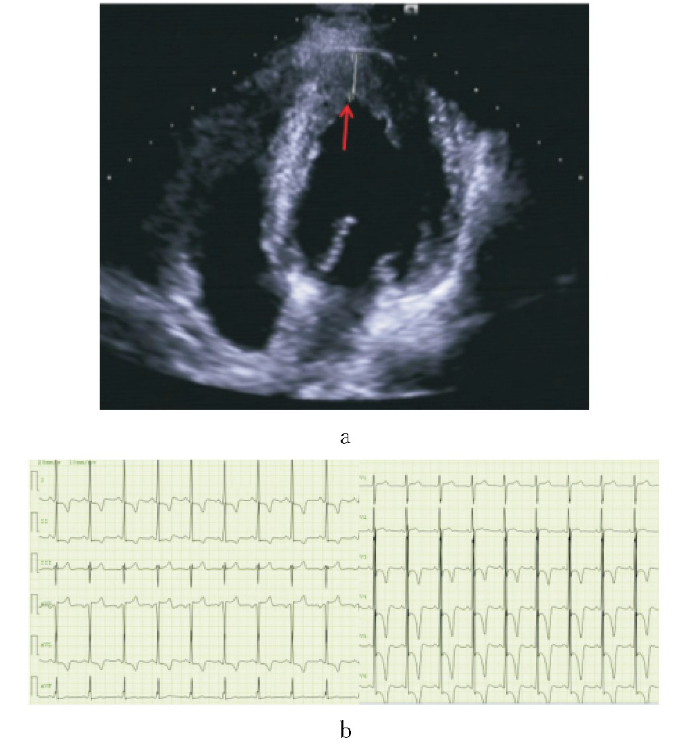 图1 1例典型AHCM患者的超声心动图和心电图